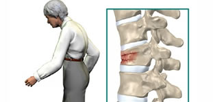 Fracturas por osteoporosis