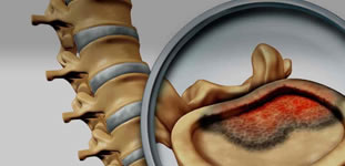 Tumores de Columna Vertebral